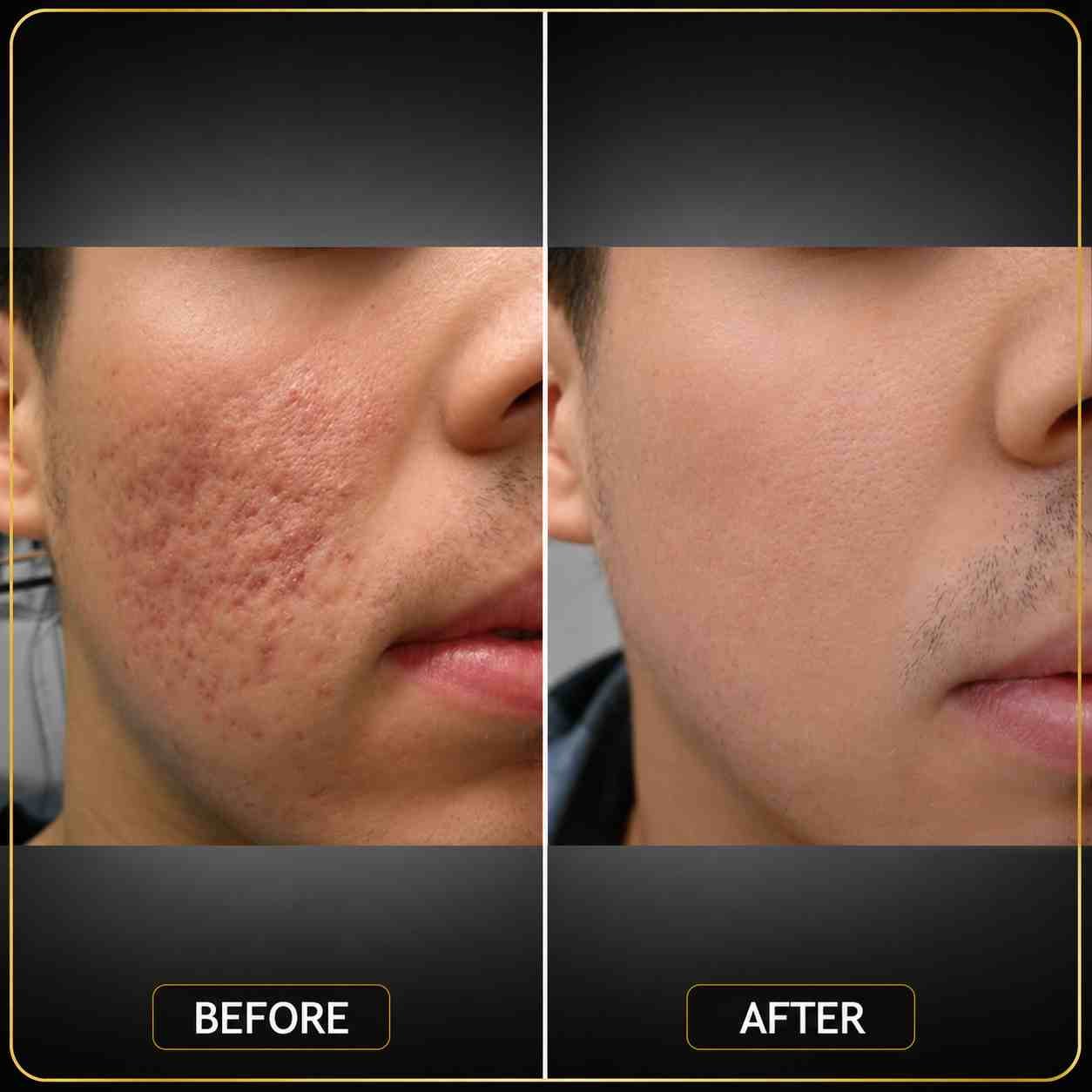Acne Scar Treatment - After 4 Months